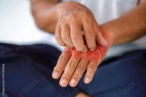 Scratching a man's hand caused by an allergy to something or an insect sting.