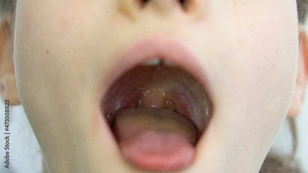 Wide open mouth with a tongue stuck out, view of the uvula ...   