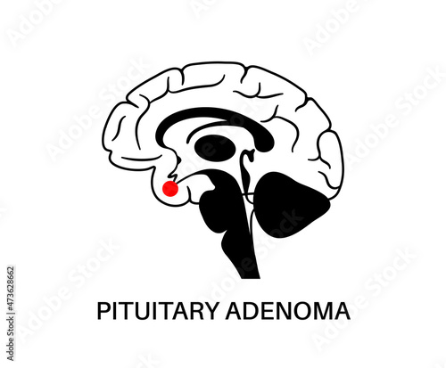 Pituitary adenoma cancer
