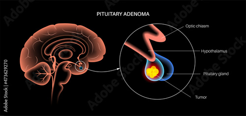 Pituitary adenoma cancer