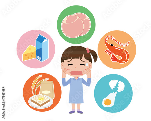 食物アレルギーで蕁麻疹が出る女の子