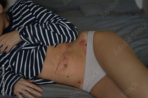 consequences after peritonitis