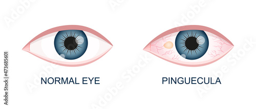 Eye healthy and with pinguecula. Conjunctival degeneration before and after surgery. Eye disease. Human organ of vision with pathology. Vector realistic illustration. photo