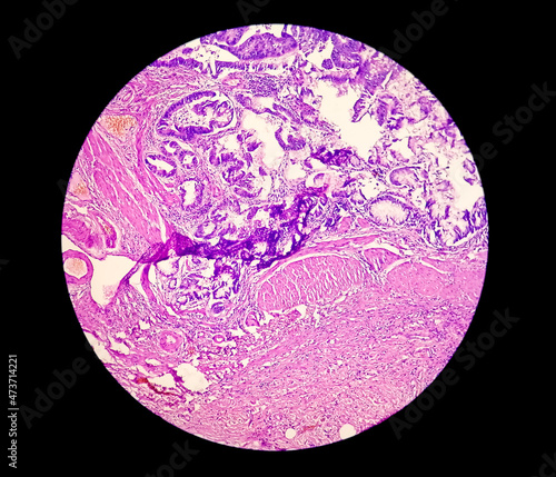 Photomicrograph showing adenocarcinoma. cancer, oncology, histology. 40x