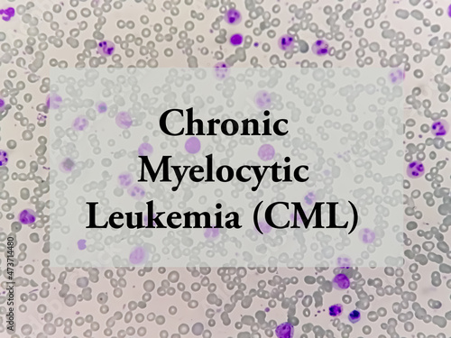 Chronic myelocytic leukemia (CML). Hematology. Health and medical concept. photo