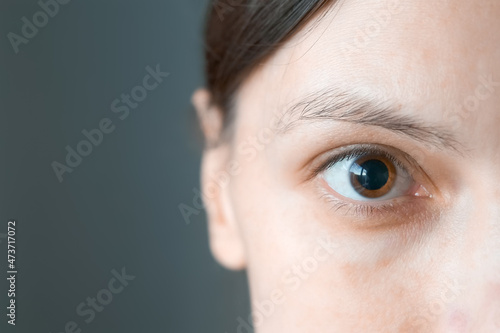 Close-up of a woman's brown eye with dilated big pupil. Eye drops after a visit to an ophthalmologist. Concept of healthy vision. Ophthalmological examination and treatment.