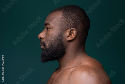 African man with skin problems side profile