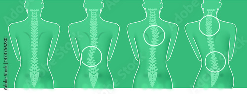 Schiena donna colonna vertebrale problemi scoliosi