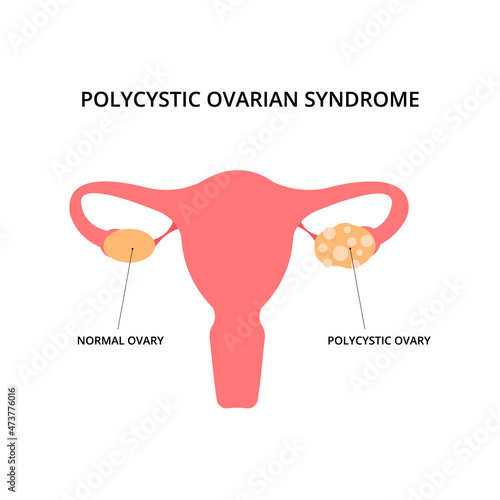 Polycystic ovarian syndrome. Uterus, infertility, gynecology. For topics like pcos, disease, pelvic floor