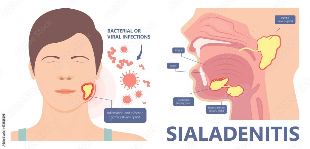 Vecteur Stock Parotid gland Sialadenitis bacterial infection Sialolithiasis  blockage swelling treat Infiltrative cancer ear nose doctor calculi stones  diagnose surgical examination inflammation saliva | Adobe Stock