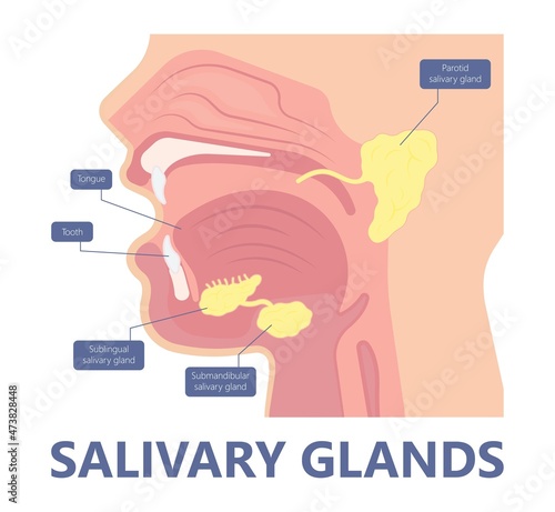 Parotid gland Sialadenitis bacterial infection Sialolithiasis blockage swelling treat Infiltrative cancer ear nose doctor calculi stones diagnose surgical examination inflammation saliva