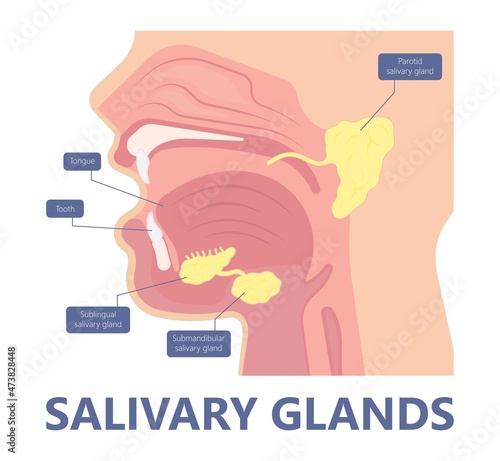 Parotid gland Sialadenitis bacterial infection Sialolithiasis blockage swelling treat Infiltrative cancer ear nose doctor calculi stones diagnose surgical examination inflammation saliva photo