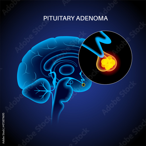 Pituitary adenoma cancer photo