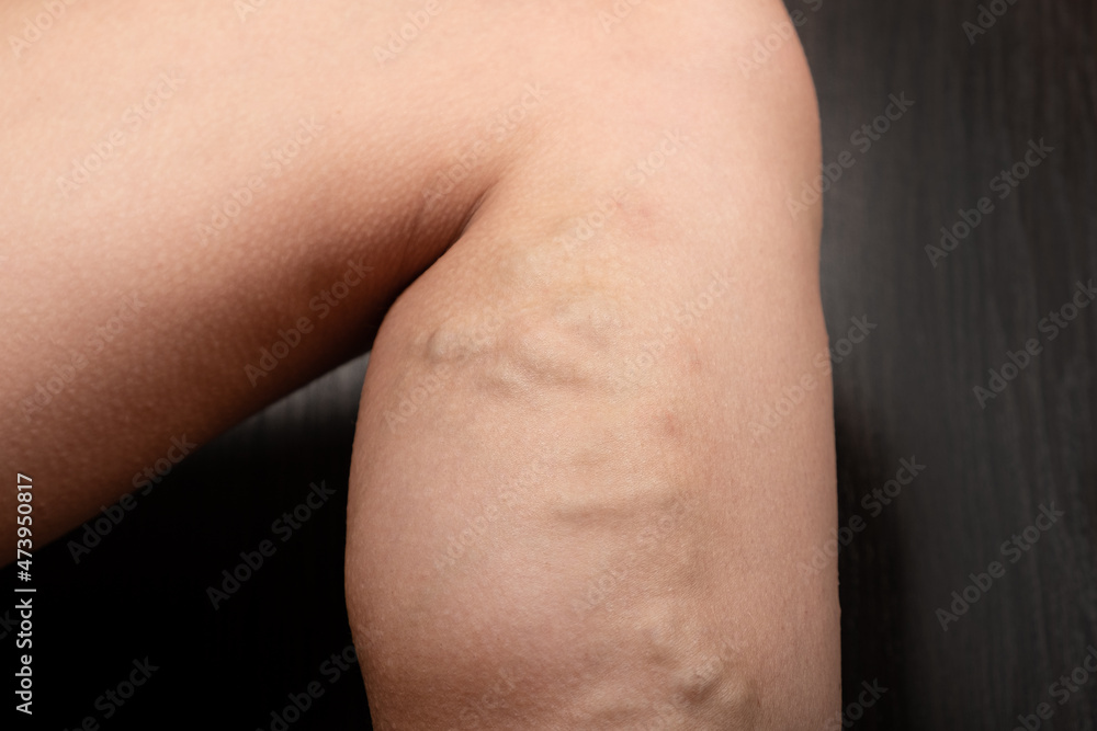 leg with varicose veins, blockage of veins. leg with varicose veins, blockage of veins.