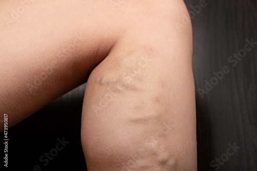leg with varicose veins, blockage of veins.
