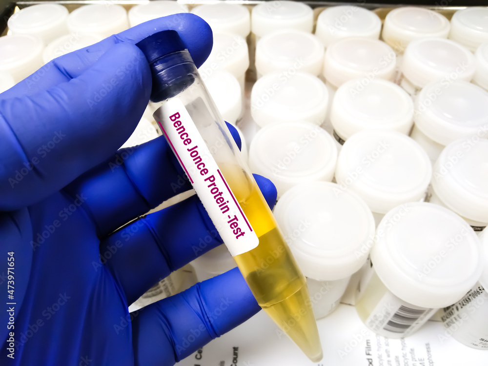 Urine specimen for Bence Jonce Protein test at medical laboratory