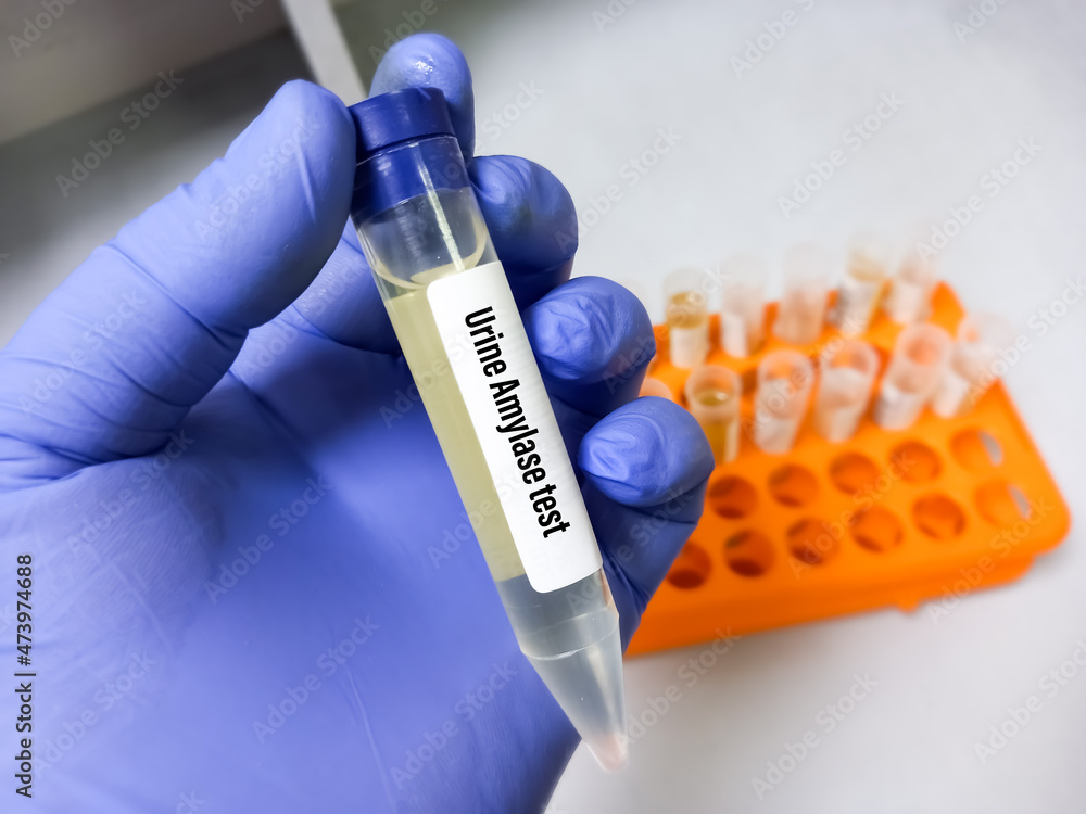 Urine sample for urinary amylase test, laboratory background. Closeup. Urinalysis. Stock Photo