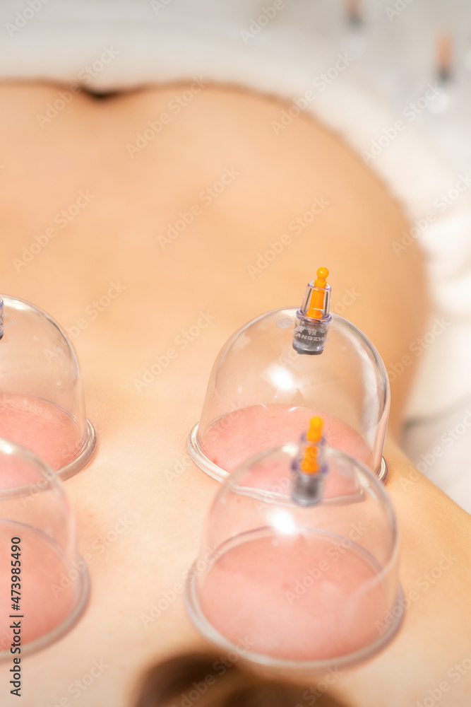 Young caucasian woman receiving cupping therapy in spa clinic. Islamic female medicine Young caucasian woman receiving cupping therapy in spa clinic. Islamic female medicine