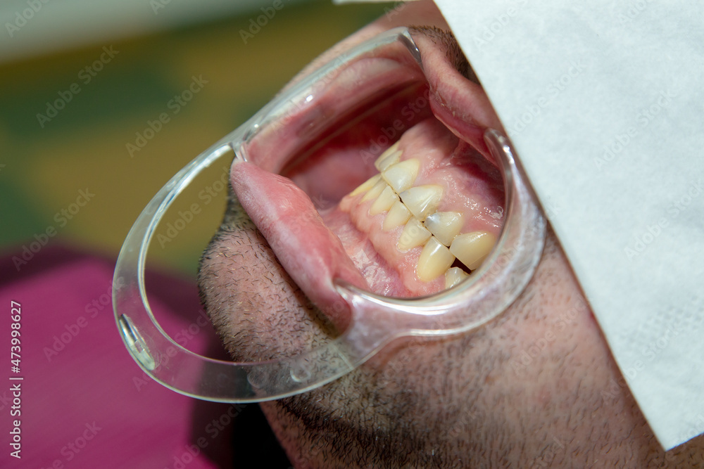 Obraz premium open mouth for dental treatment