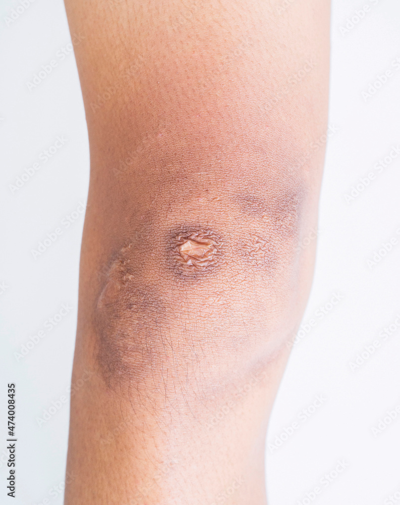 Fototapeta premium Scar and blemishes Dark spots on the skin of the person on the leg