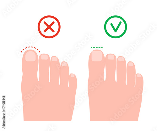 Cut nail on leg wrong and right, health pedicure. Circle and straight cutting nail. Prevention of ingrown nails. Vector illustration