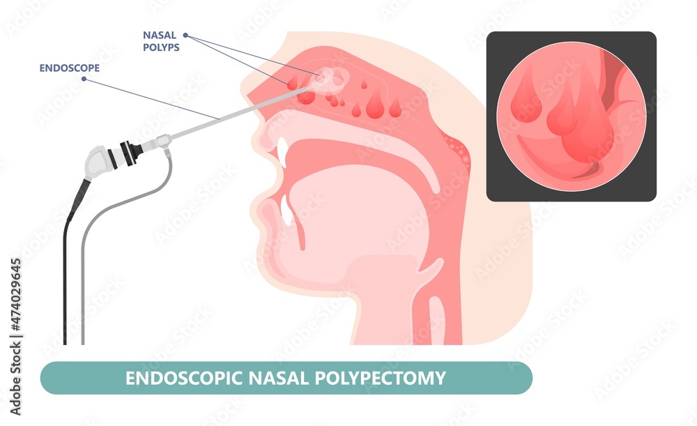 Nasal polypectomy Throat back voice box larynx vocal cord pain airway