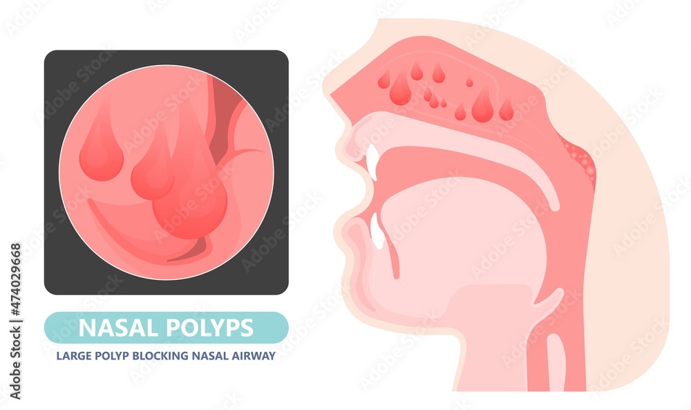 Nasal polypectomy Throat back voice box larynx vocal cord pain airway