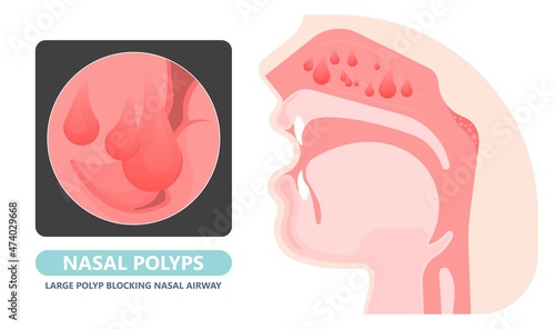 Nasal polypectomy Throat back voice box larynx vocal cord pain airway endoscopic sinus surgery ear nose sleep apnea oral airway septal obstructive biopsy tumor Pharynx flexible fibre optic