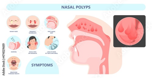 Nasal polypectomy Throat back voice box larynx vocal cord pain airway endoscopic sinus surgery ear nose sleep apnea oral airway septal obstructive biopsy tumor Pharynx flexible fibre optic photo