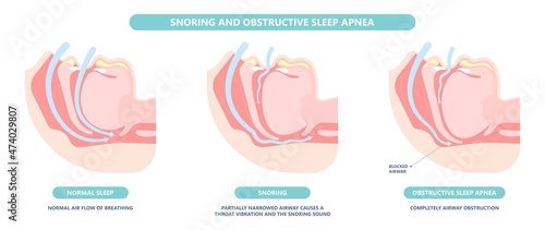 Somnoplasty. Throat back voice box larynx vocal cord pain airway endoscopic sinus surgery ear nose sleep apnea oral airway septal obstructive biopsy tumor Pharynx flexible fibre optic polypectomy