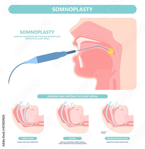 Somnoplasty. Throat back voice box larynx vocal cord pain airway endoscopic sinus surgery ear nose sleep apnea oral airway septal obstructive biopsy tumor Pharynx flexible fibre optic polypectomy