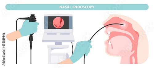 Nasal Endoscopy. Throat back voice box larynx vocal cord pain airway endoscopic sinus surgery ear nose sleep apnea oral airway septal obstructive biopsy tumor Pharynx flexible fibre optic polypectomy photo