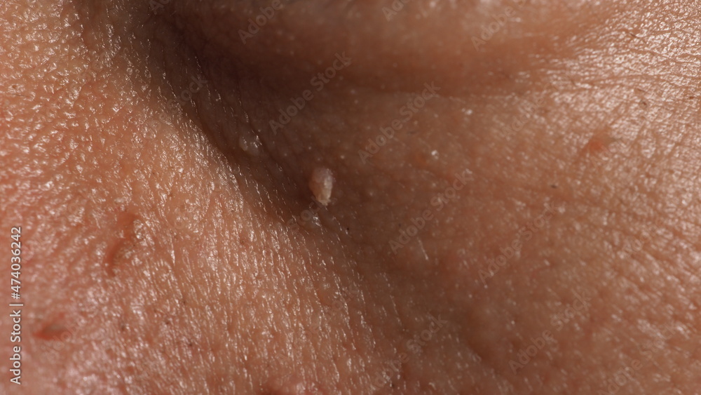 Fototapeta premium Wart on face. Macro shot of wart near eye. Papilloma on skin around eye nose and neck. Close up of birthmark Papilla or mole on skin. small hard. benign growth on the skin. caused by virus. skincare.