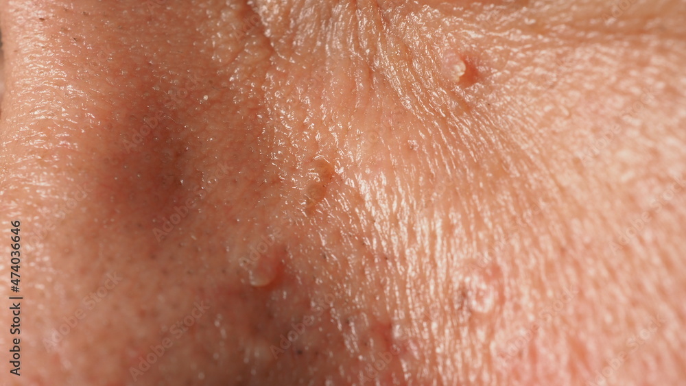 Fototapeta premium Wart on face. Macro shot of wart near eye. Papilloma on skin around eye nose and neck. Close up of birthmark Papilla or mole on skin. small hard. benign growth on the skin. caused by virus. skincare.