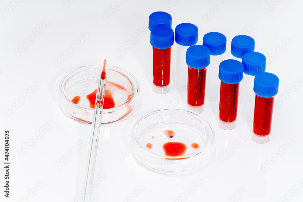 Blood test analysis with Petri dish close up.Blood coronavirus test