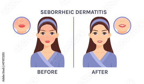 Seborrheic Dermatitis on Beautiful Face. Skin Problem. Close up of Dandruff and Redness. Treatment. Before After. Healthy Skin and Happy Woman. Cartoon style. Vector image for Beauty Medical design.