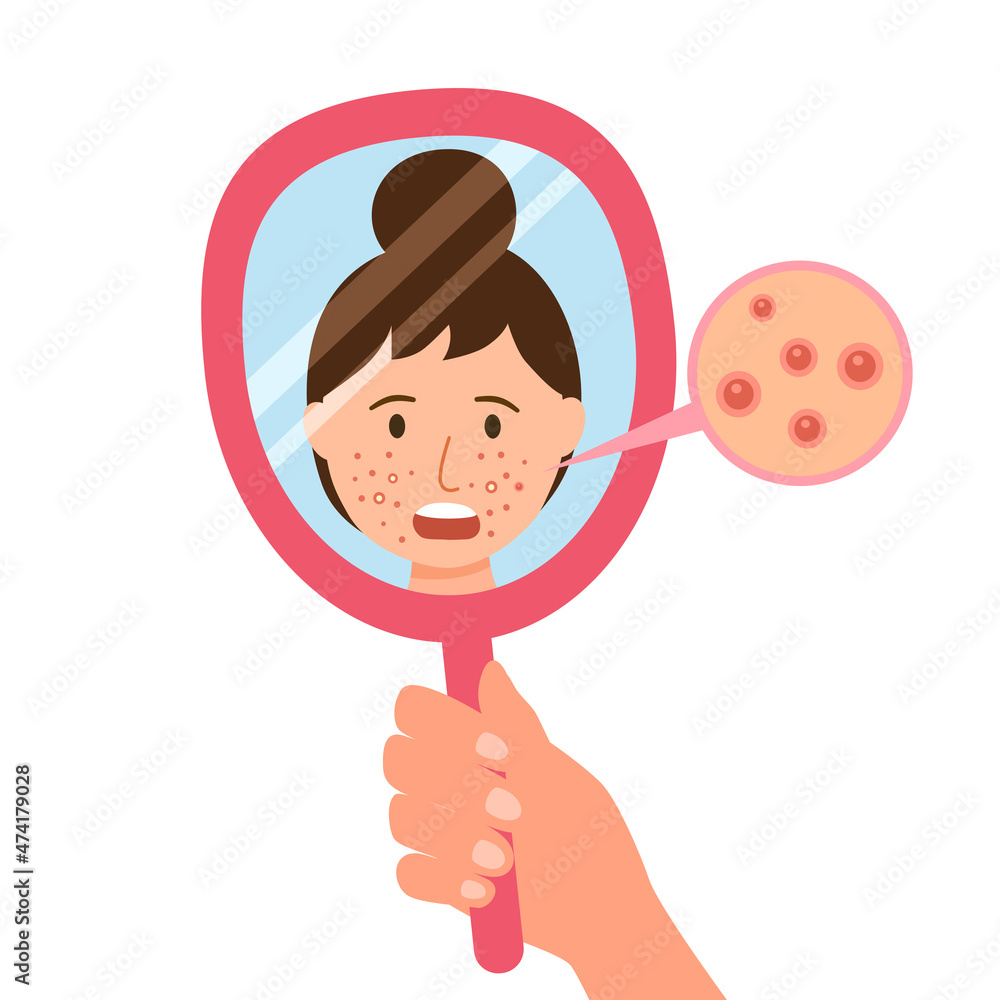 Young woman hand mirror worrying about her acne on face in flat design. Pimple problem on female skin. Young woman hand mirror worrying about her acne on face in flat design. Pimple problem on female skin.
