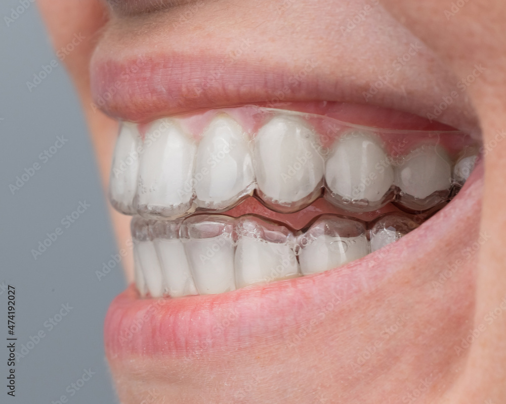 Fototapeta premium Close-up of a caucasian woman smiling with aligners on her teeth. Macro.