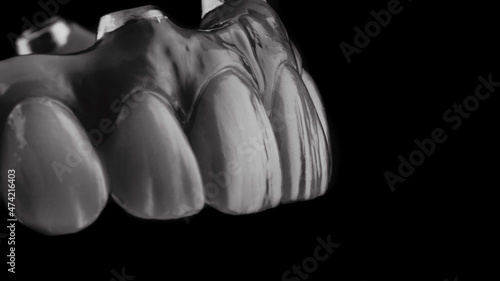 Dental implants and dentures in close-up Siemke on a black background
