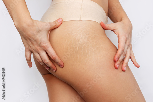 Canvastavla Close-up of a female thigh with white stretch marks from a sharp weight loss or weight gain isolated on a white background