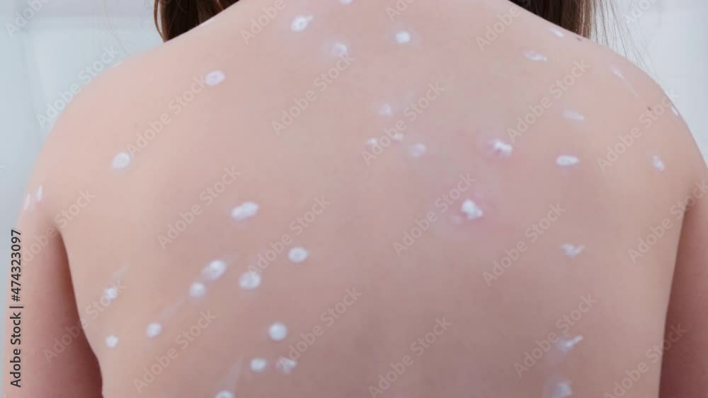 Chinelpocks Rash back girl with chickenpox, antiseptic cream applied to the rash. Rash ...