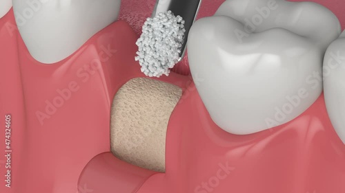 3d dental bone grafting and bone augmentation procedure photo