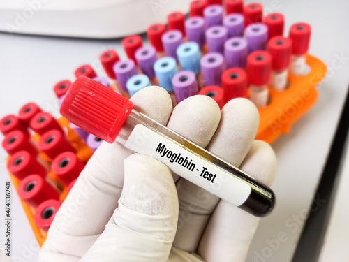 Blood sample for Myoglobin test, diagnosis of acute myocardial infraction (AMI).focus view