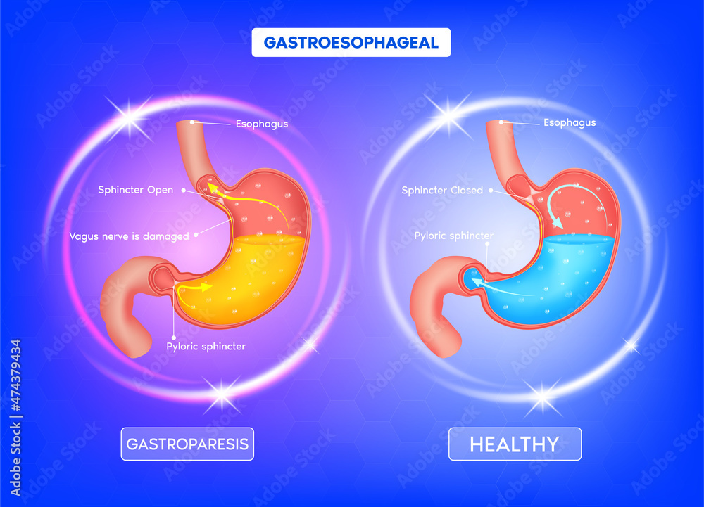 Healthy and sick stomach. Peppers and bananas in the abdomen. Stomach heartburn. Gastritis and