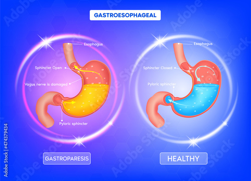Healthy and sick stomach. Peppers and bananas in the abdomen. Stomach heartburn. Gastritis and acid reflux. Healthy food nutrition concept. 3D vector.
