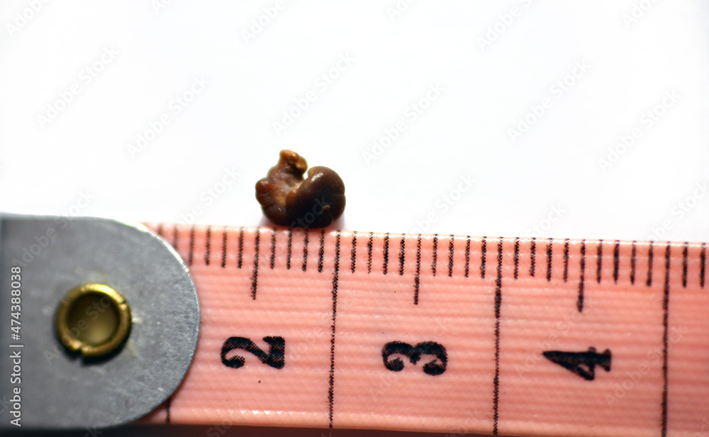 Nephrolithiasis, a single irregular brown kidney stone (renal calculus