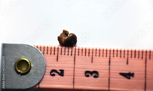 Nephrolithiasis, a single irregular brown kidney stone (renal calculus or nephrolith) on white background, scale in centimeters, the stone is around 6 millimeters in size that passed in urine photo