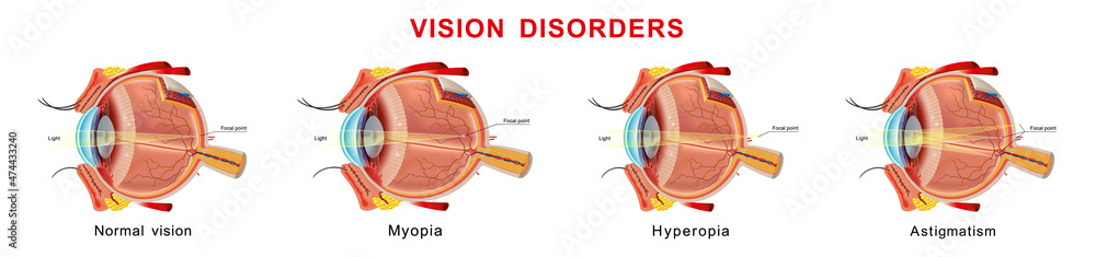 Eyesight disorders. Normal eye, myopia, hyperopia and astigmatism - obrazy, fototapety, plakaty 
