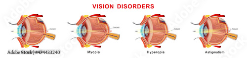 Eyesight disorders. Normal eye, myopia, hyperopia and astigmatism photo
