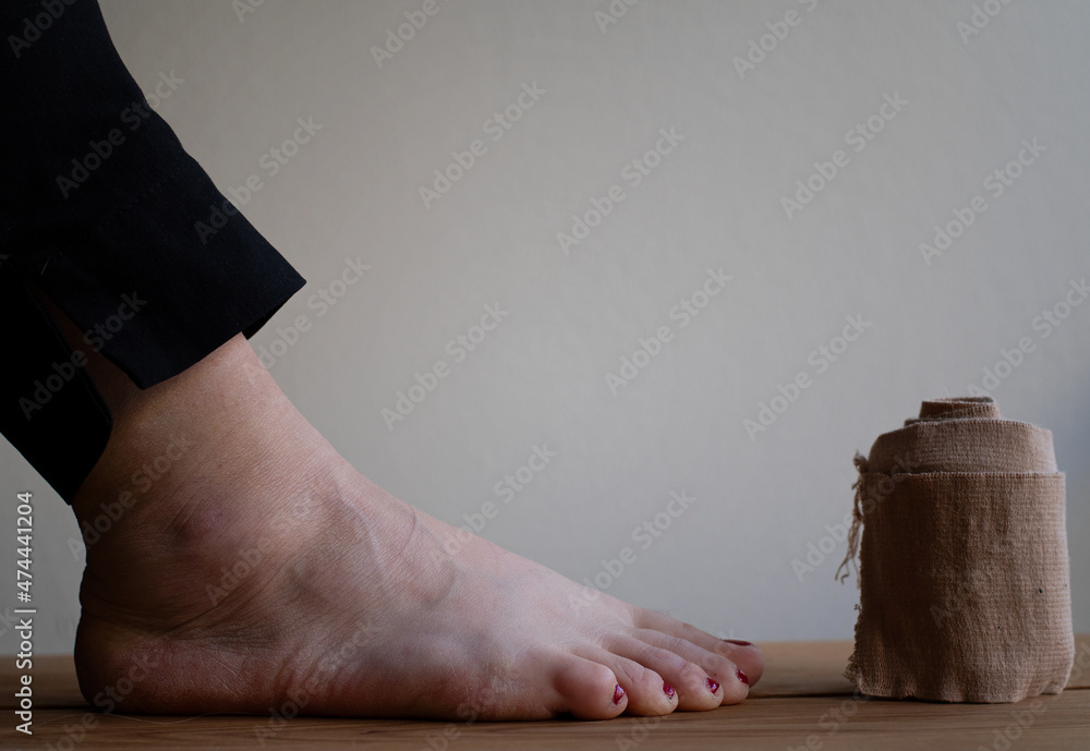 Concept of injury and treatment with a compression bandage roll and swollen foot due to a